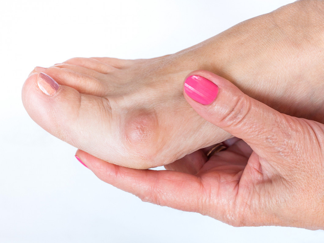 Bunion Treatment, Painful Bunions Bozeman & Livingston, MT Bozeman